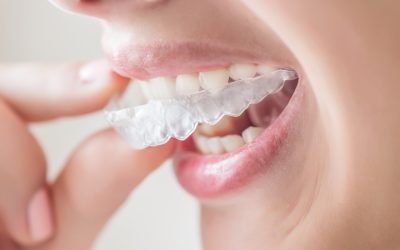 Smile With Confidence Using Professional Teeth Whitening Services Colton CA Residents Trust