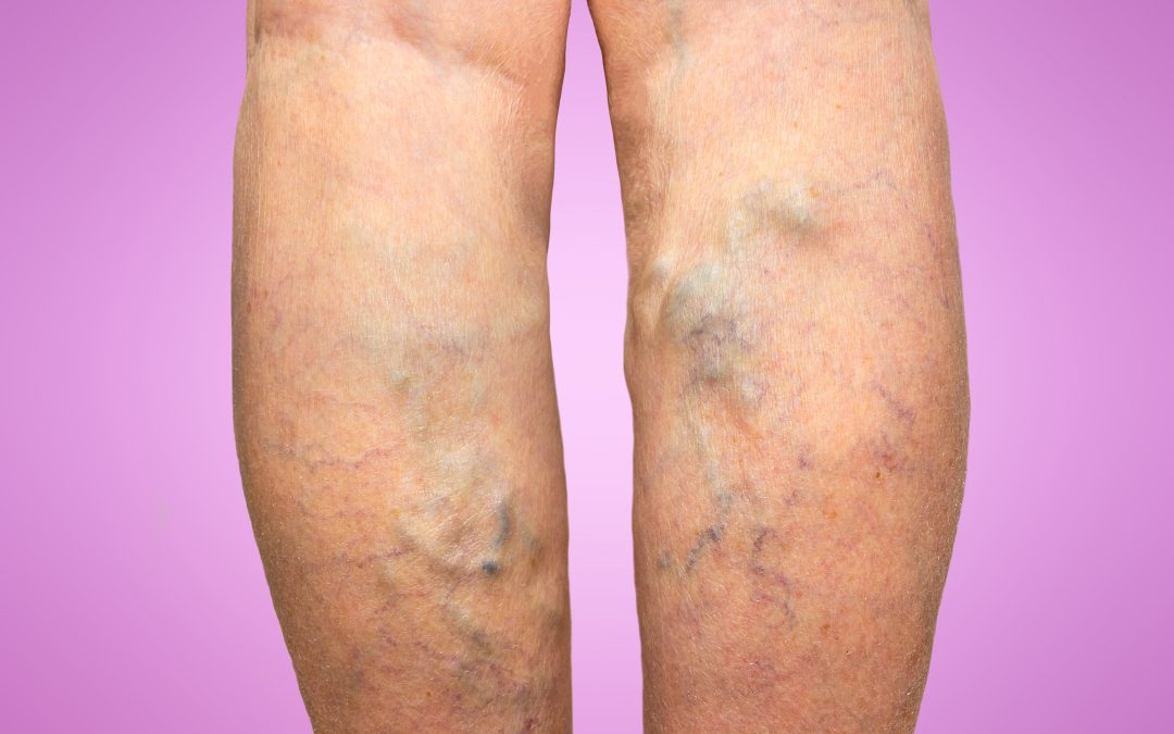 Get Lasting Relief from Leg Discomfort with Spider Veins Treatment in Petersburg, VA