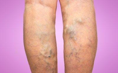 Get Lasting Relief from Leg Discomfort with Spider Veins Treatment in Petersburg, VA