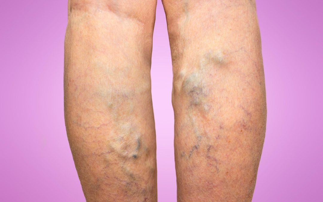 Life After Knee Replacement Surgery in Richmond, VA: Benefits and Patient Stories