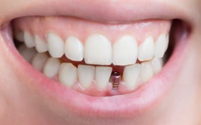 Unlock a Confident Smile With Dental Dentures Richland, WA Patients Trust for Comfort